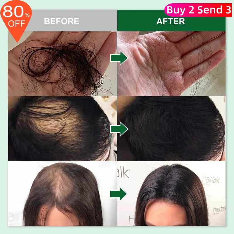 Rosemary Oil Hair Growth Products Ginger Anti Loss Fast